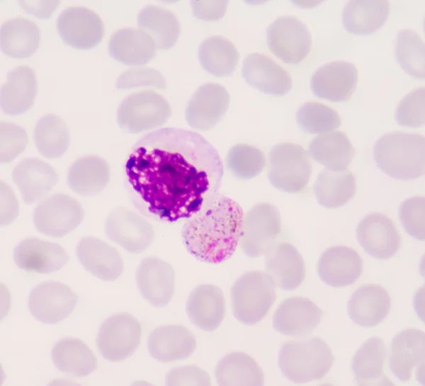 Películas de sangre para el parásito de la malaria —  Fotos de Stock