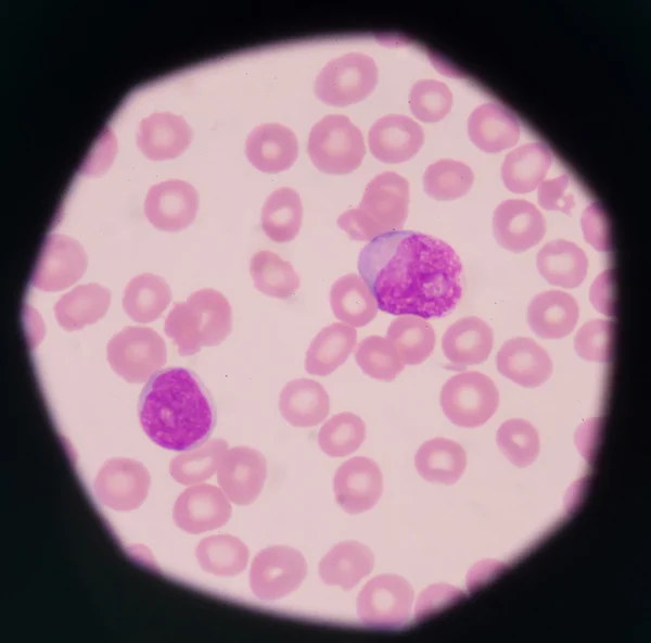 Вибухові клітини на периферійних зображеннях крові . — стокове фото