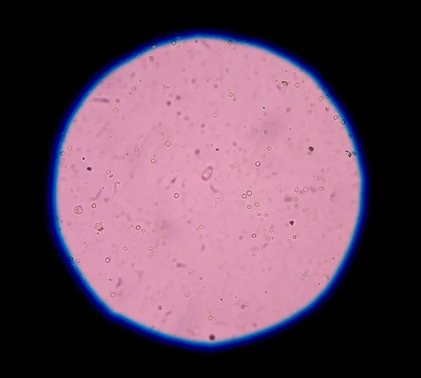 Calcium oxalate crystal in urine analysis. — Stock Photo, Image