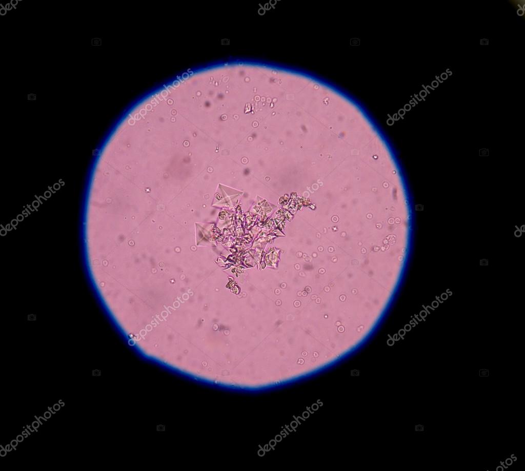Calcium oxalate crystal in urine analysis. Stock Photo by ©toeytoey