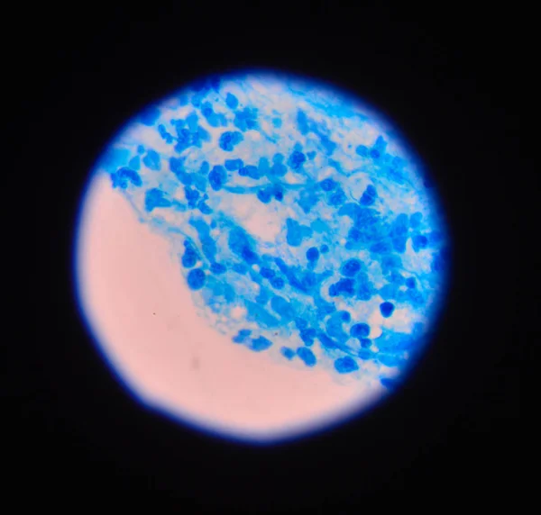 Ramificación de las células de levadura en ciernes con pseudohifas en la orina gram st — Foto de Stock