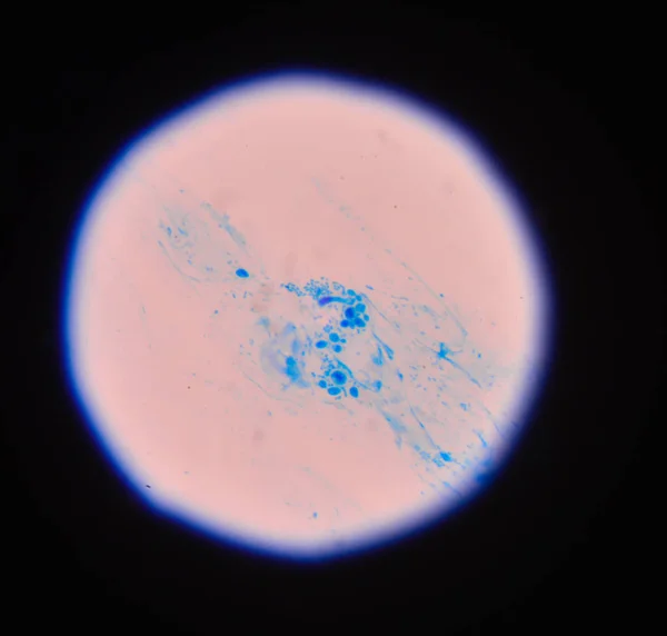 Розгалужені бутонізаційні дріжджові клітини з псевдогіфами в грамі сечі вул — стокове фото
