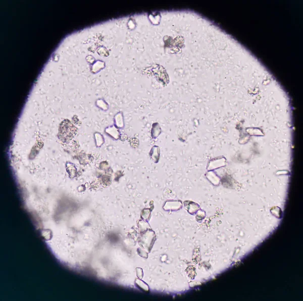 Fosfato triplo moderato con batteri nell'analisi delle urine medica — Foto Stock