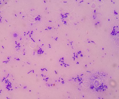 Sepsis veya septisemi yaşamı tehdit eden bir hastalık olduğunu. 