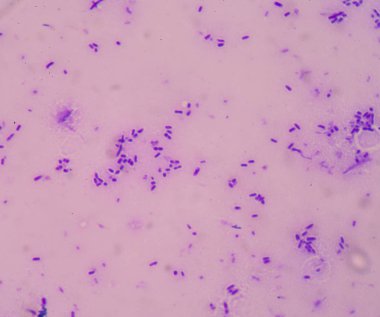 Sepsis veya septisemi yaşamı tehdit eden bir hastalık olduğunu. 