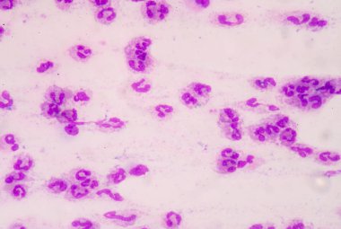 Sepsis veya septisemi yaşamı tehdit eden bir hastalık olduğunu. 