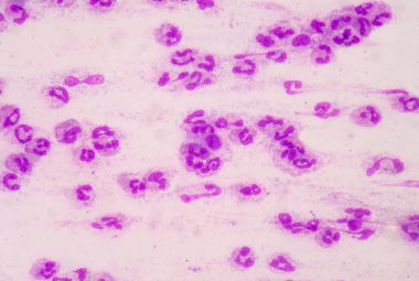 Sepsis veya septisemi yaşamı tehdit eden bir hastalık olduğunu. 