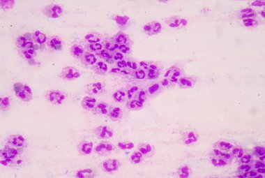 Sepsis veya septisemi yaşamı tehdit eden bir hastalık olduğunu. 