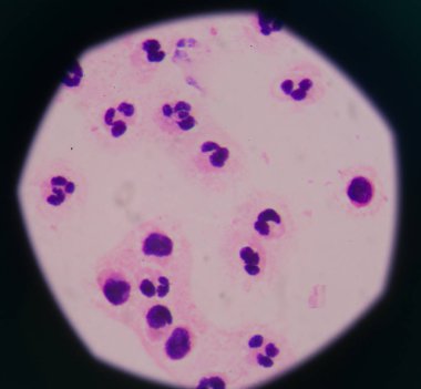 Sepsis veya septisemi yaşamı tehdit eden bir hastalık olduğunu. 