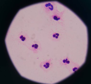 Sepsis veya septisemi yaşamı tehdit eden bir hastalık olduğunu. 