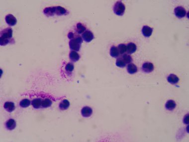 Sepsis veya septisemi yaşamı tehdit eden bir hastalık olduğunu. 