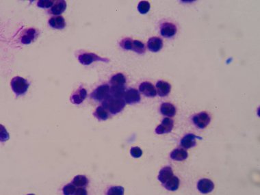 Sepsis veya septisemi yaşamı tehdit eden bir hastalık olduğunu. 