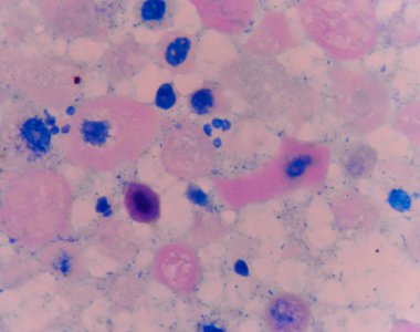 Anormal hücreler mikroskopla hücre pembe.