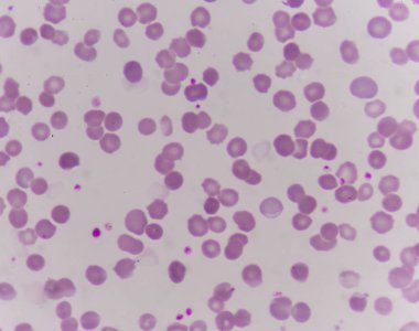 anormal kırmızı kan hücreleri