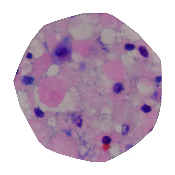 Célula cancerosa en humanos que muestra células anormales . — Foto de Stock