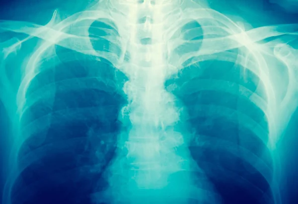 X-ray in blue tone — Stock Photo, Image