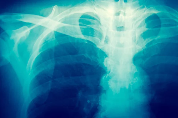 X-Ray in blauwe Toon — Stockfoto