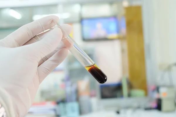 Sangue coagulado com soro no fundo do laboratório do tubo tes . — Fotografia de Stock