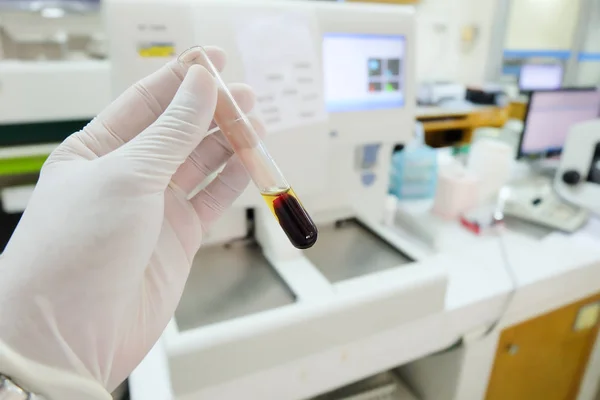 Clotted blood  with serum in tes tube  laboratory background. — Stock Photo, Image