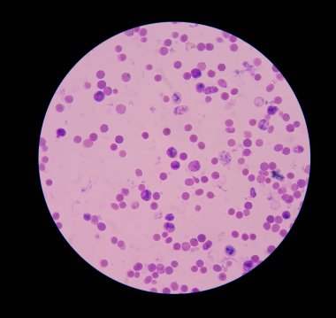 Reticulocyte with red blood cells on blood smear. clipart