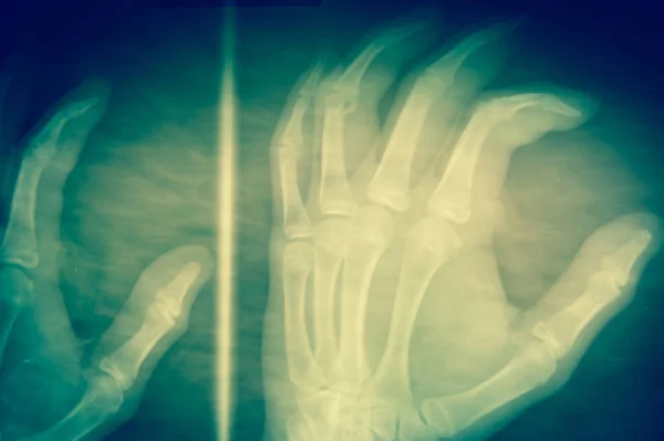 Kézi röntgen a sötét háttér előtt orvosi koncepció. — Stock Fotó