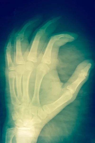 Radiografia della mano su sfondo scuro concetto medico . — Foto Stock