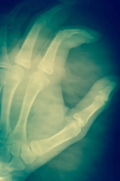 Raio-X de mão em fundo escuro conceito médico . — Fotografia de Stock