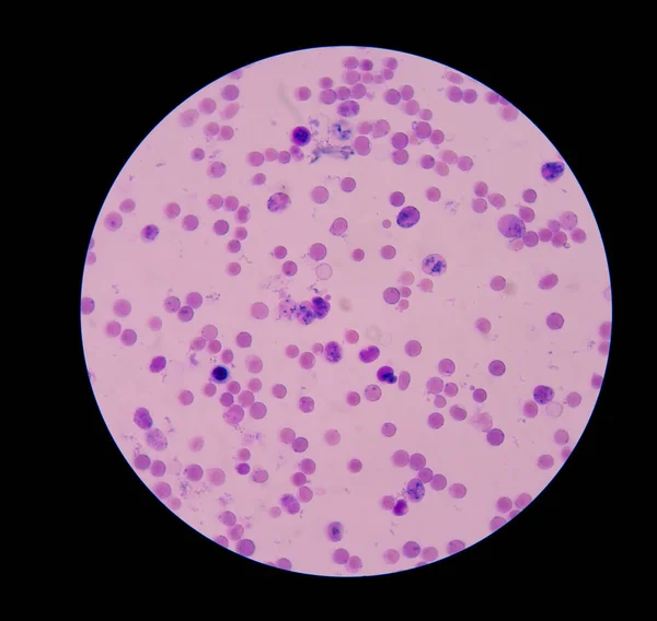 Ретикулоцит з еритроцитами на мазку крові . — стокове фото