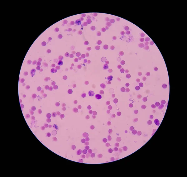 Ретикулоцит с эритроцитами на мазке крови . — стоковое фото