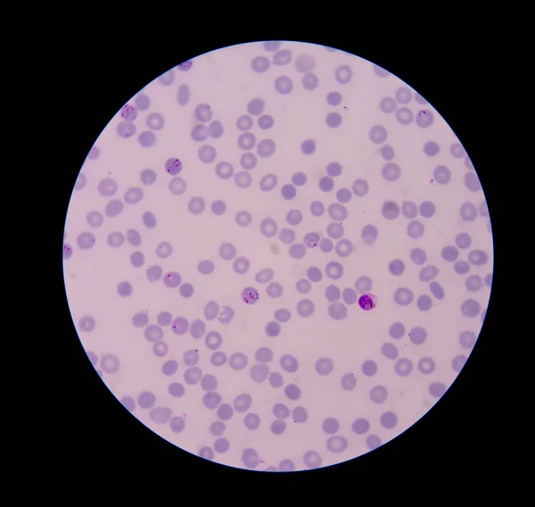 Malaria forma anello infezione sui globuli rossi . — Foto Stock