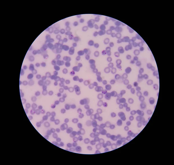 Sıtma halka formu enfeksiyon kırmızı kan hücreleri üzerinde. — Stok fotoğraf