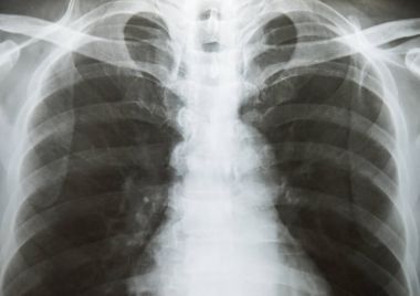  Göğüs röntgeni göster alveoler infiltrasyon