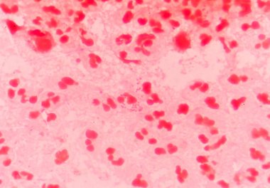 gram negatif diplococci hücre içi