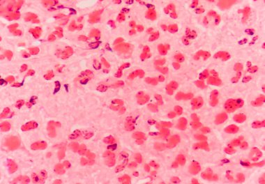 gram negatif diplococci hücre içi