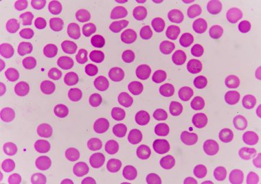 Normochromic normacytic kırmızı kan hücreleri