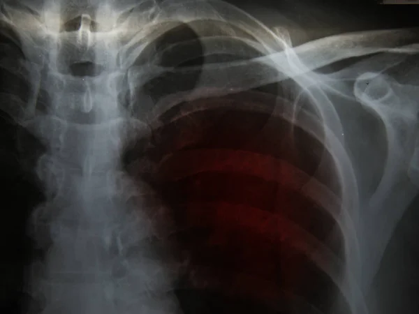 肺结核 (Tb): 胸部 x 光显示肺泡 infilt — 图库照片