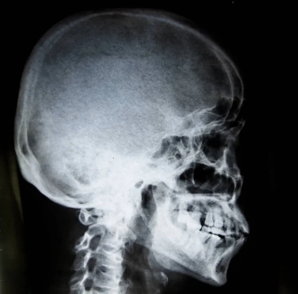 Boczne czaszki x-ray film — Zdjęcie stockowe