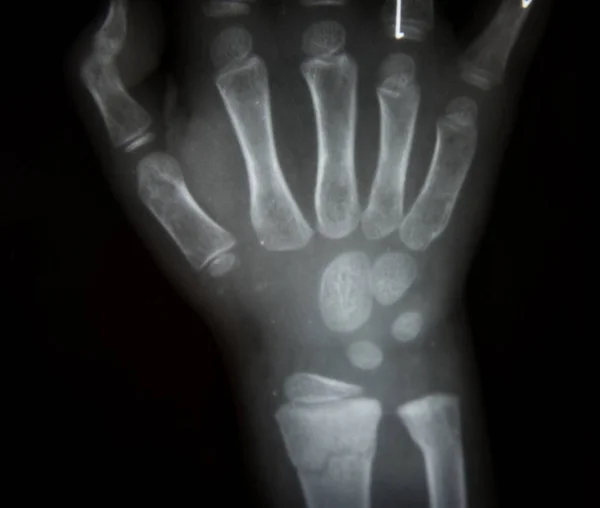 Ręka x-ray film — Zdjęcie stockowe