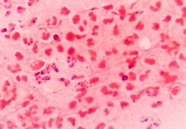 Diplococos gram negativos intracelulares — Stock Photo