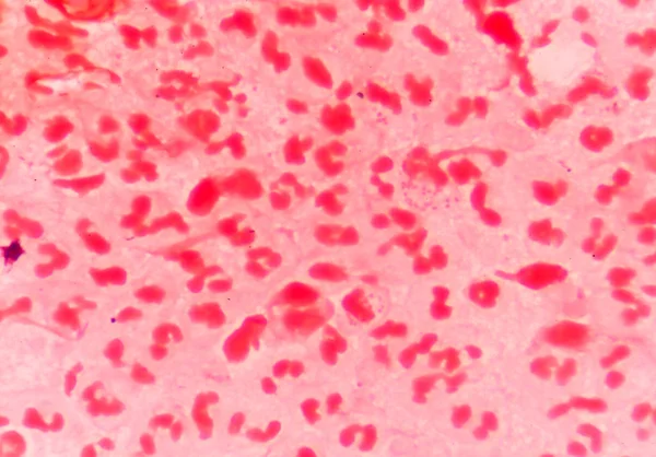 Gram négatif diplocoques intracellulaires — Photo