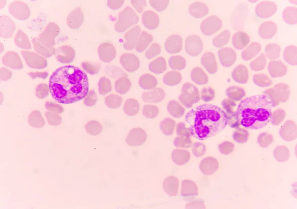 Abnormal neutrophil in blood smear. — Stock Photo, Image