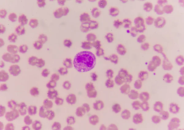 Abnormal neutrophil in blood smear. — Stock Photo, Image