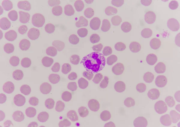 혈액 얼룩에 비정상적인 neutrophil. — 스톡 사진