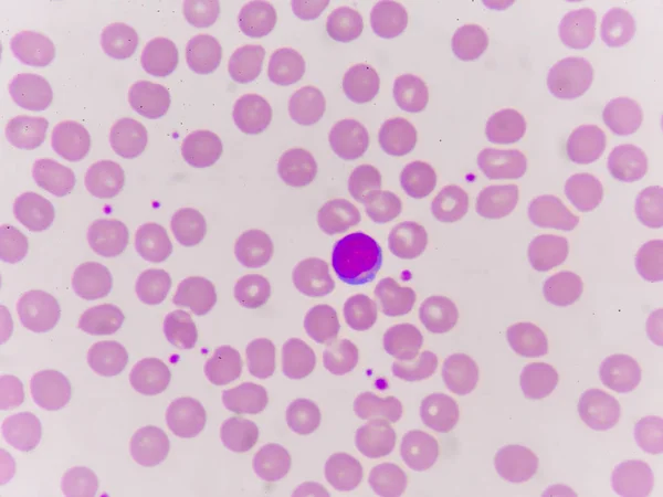 Glóbulos rojos normacíticos normocrómicos — Foto de Stock