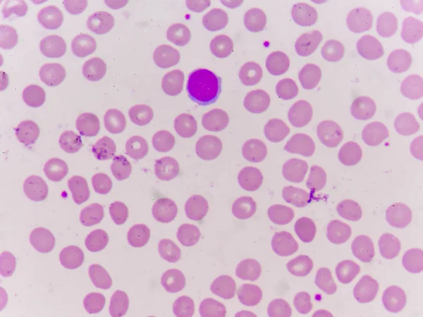 Normochromic normacytic rode bloedcellen — Stockfoto