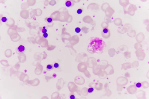 Glóbulos rojos anormales —  Fotos de Stock