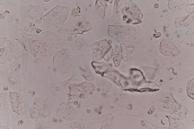 Epitel hücrelerinde orta idrar örneği