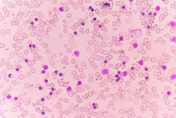 Abnormal red blood cells