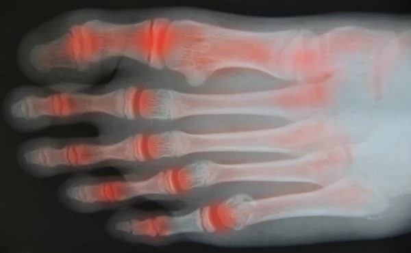 Fechar o raio-X do pé — Fotografia de Stock