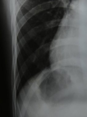 Göğüs x-ray tıbbi bilim arka kapatmak